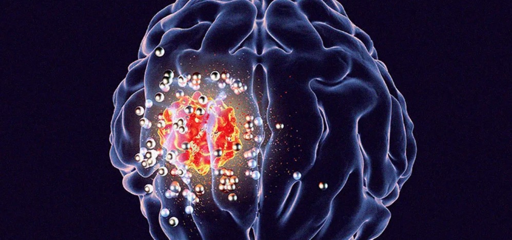 醫(yī)生發(fā)明一種可消滅腫瘤的腦植入物-肽度TIMEDOO