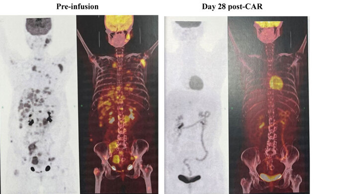 中國(guó)專家CAR-T細(xì)胞療法研究新突破：復(fù)發(fā)或難治性B細(xì)胞淋巴瘤患者或有福音-肽度TIMEDOO