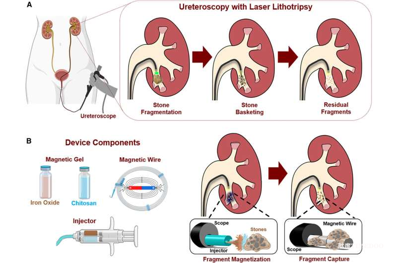 斯坦福團(tuán)隊(duì)開(kāi)發(fā)磁性取石新技術(shù)，有望提高手術(shù)碎石清除率-肽度TIMEDOO